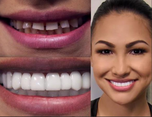 Flex Cosmetic Full Set Teeth